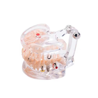 32 Tooth Full Month Implant Disease Teeth Model Clear Design  Dental Pathology Model